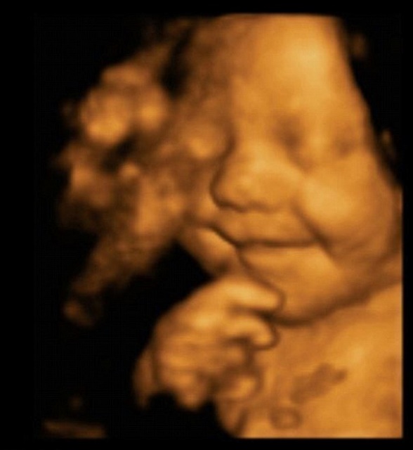 Ilustračná foto: Na snímke 3D Ultrazvuk zachytáva usmievajúce sa nenarodené dieťa