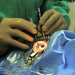 Očný chirurg Roman Ondreička implantuje pacientovi aniridickú šošovku