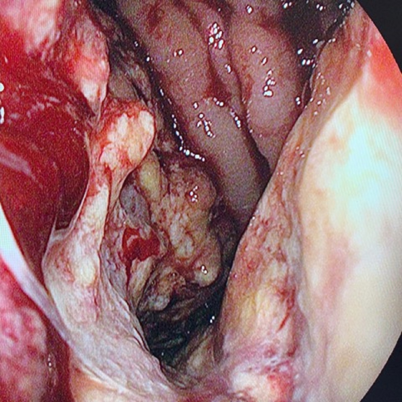 tento zhubný nádor tráviacej trubice, Štefan Hrušovský